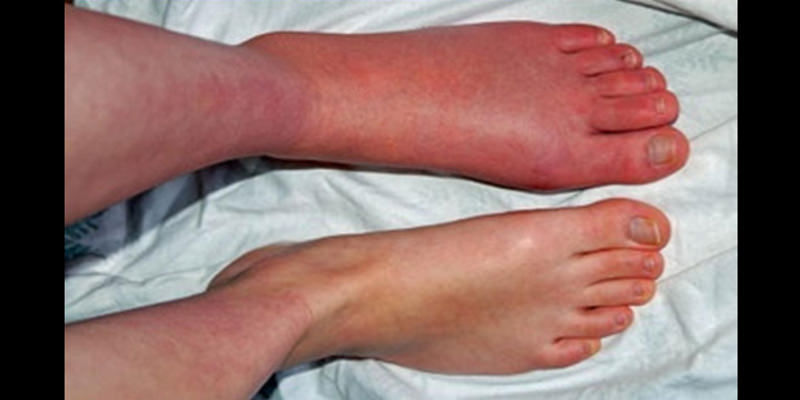 پاهای فرد نشان دهنده لخته شدن خون