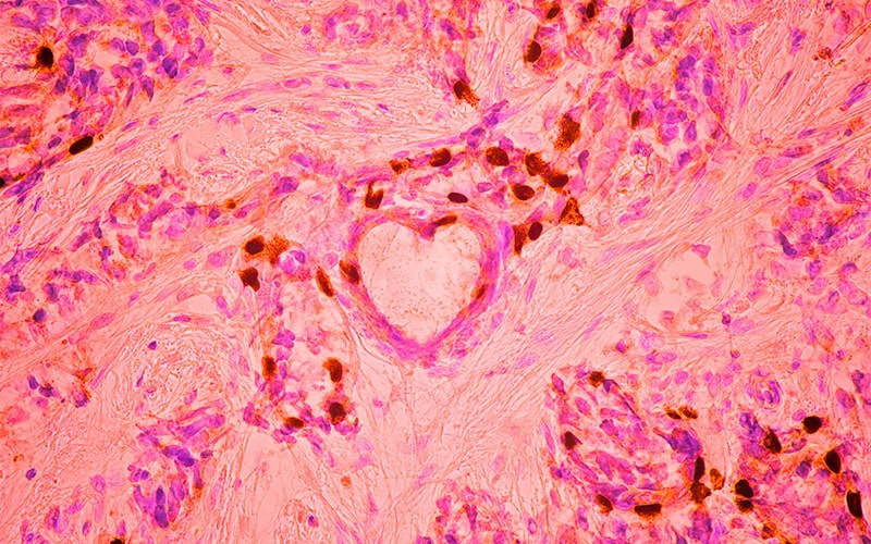 تصویر میکروسکوپی از سلول‌های سرطانی